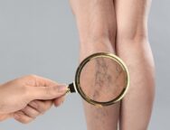 Woman,Suffering,From,Varicose,Veins,On,Light,Grey,Background,,Closeup.