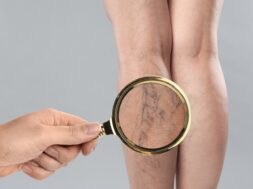 Woman,Suffering,From,Varicose,Veins,On,Light,Grey,Background,,Closeup.